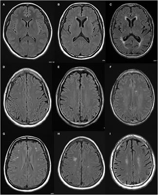 The effect of regional white matter hyperintensities on essential tremor subtypes and severity